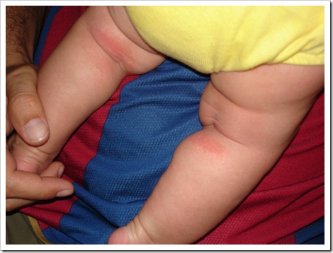 eczema-before