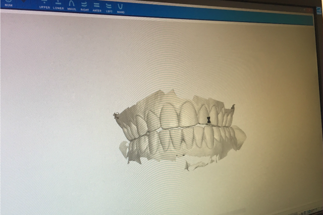 invisalign- before scan